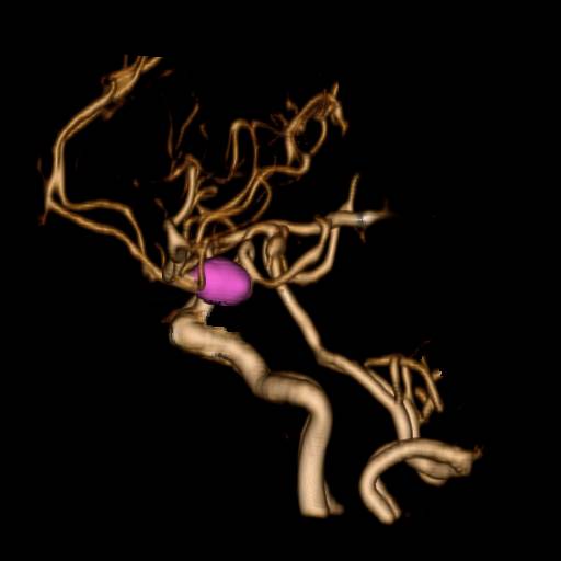 クリッピング術前