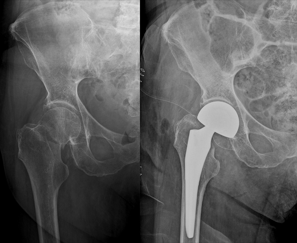 人工骨頭挿入術