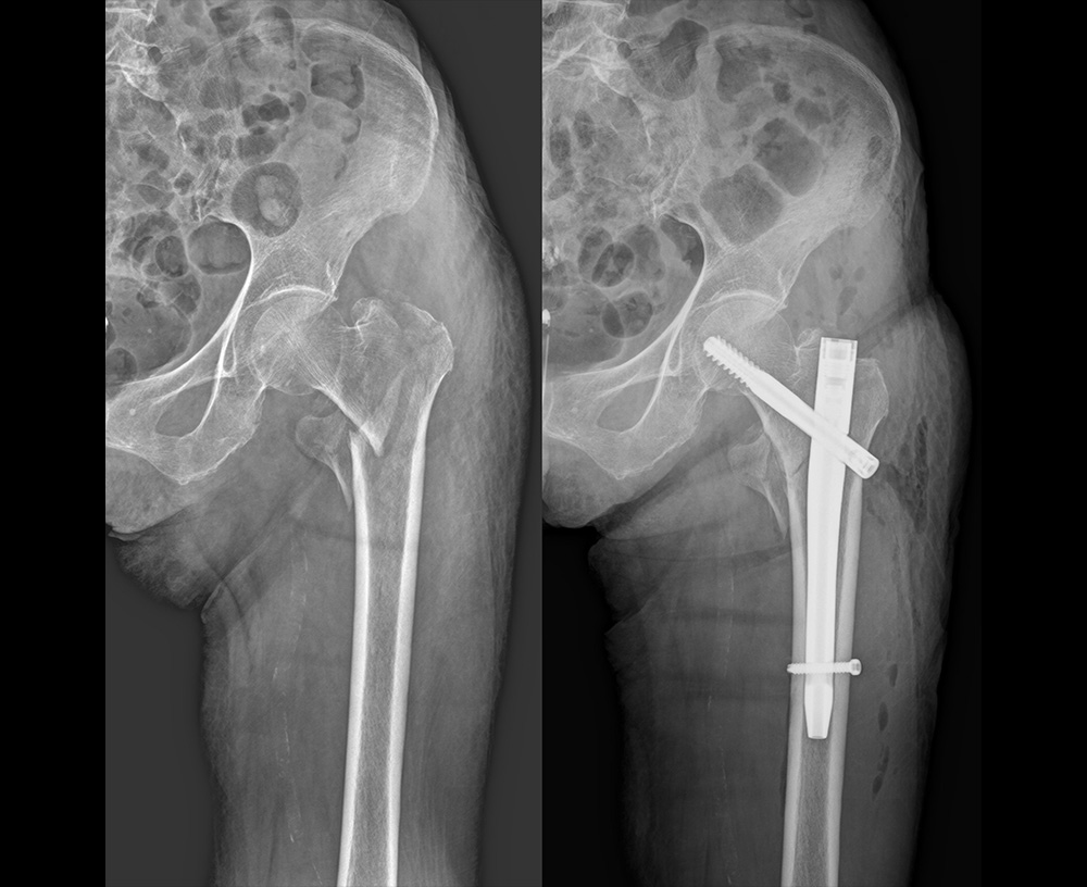 骨折観血的手術