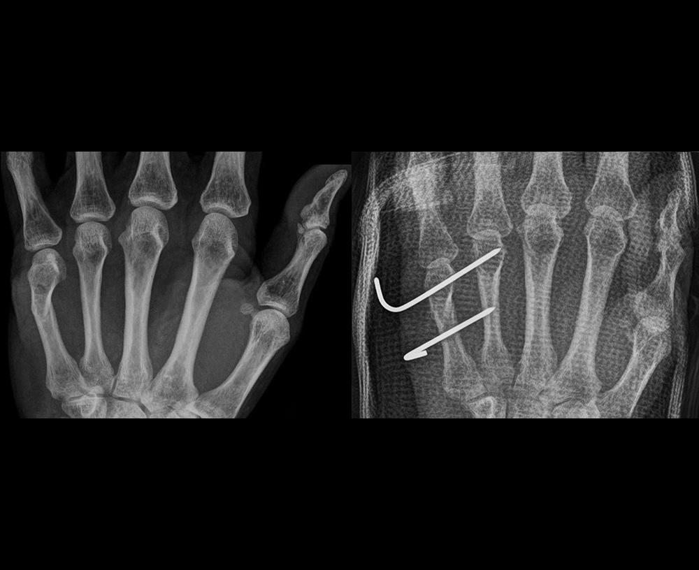 骨折経皮的銅線刺入固定